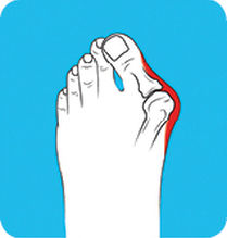 Halluks Valgus