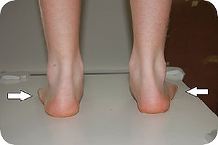 Pes Planus